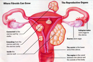 uterine-fibroids